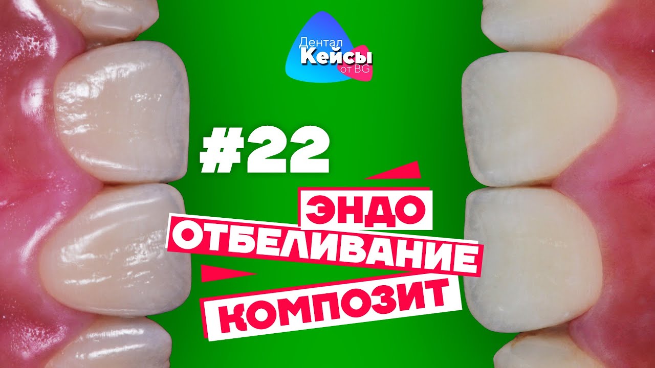 Эндо, отбеливание, композит  | Дентал Кейсы от BG #22