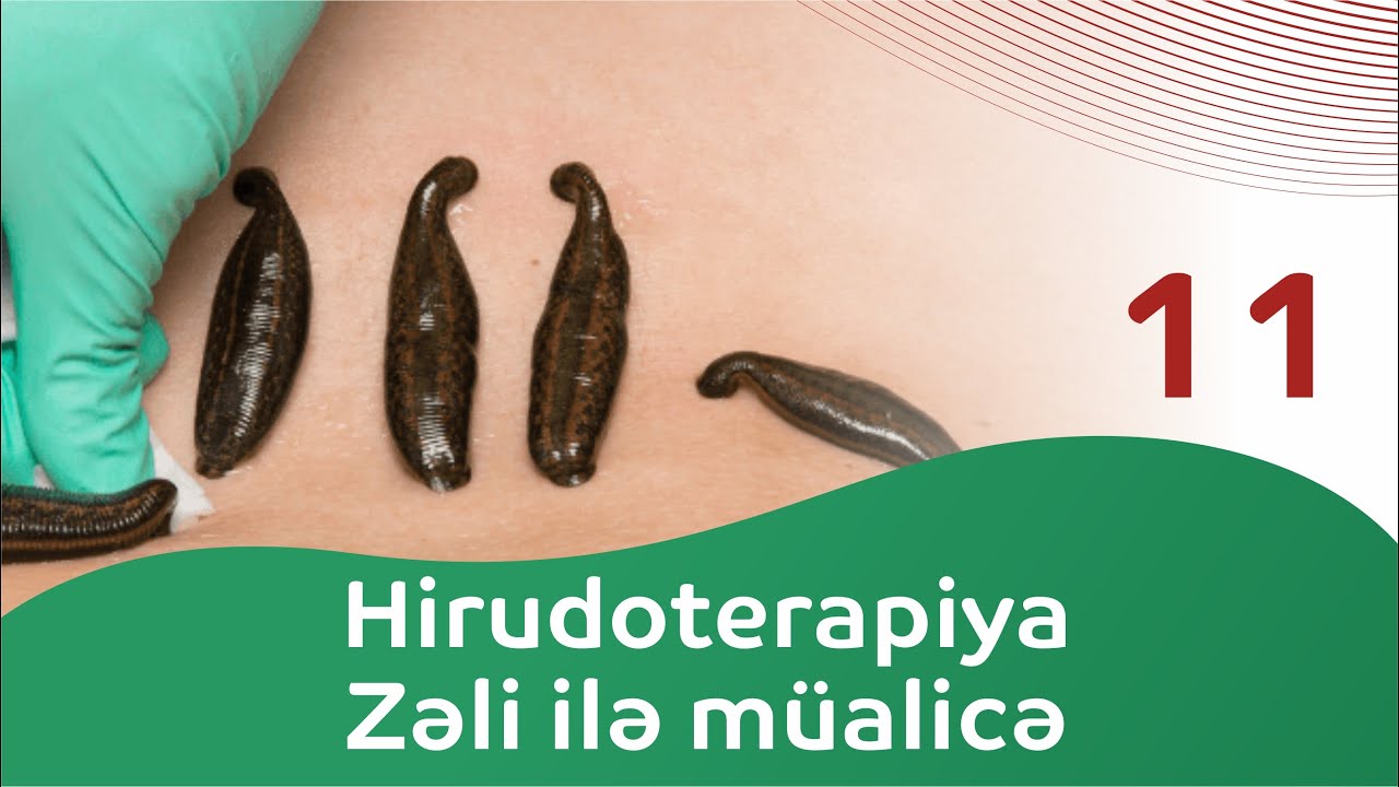 11-ci veriliş | Hirudoterapiya | Zəli ilə müalicə hansı xəstəliklərdə effektivdir?