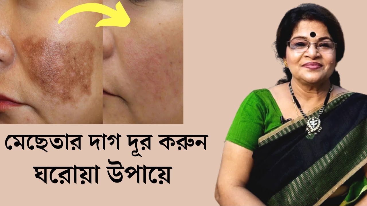 Get Rid Of Pigmentation, Dark spots | Remove Pigmentation in Just 2 Steps