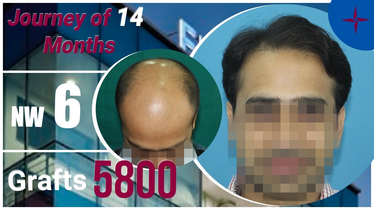Norwood Grade 6 baldness - 5800 grafts at Eugenix Hair Sciences, India