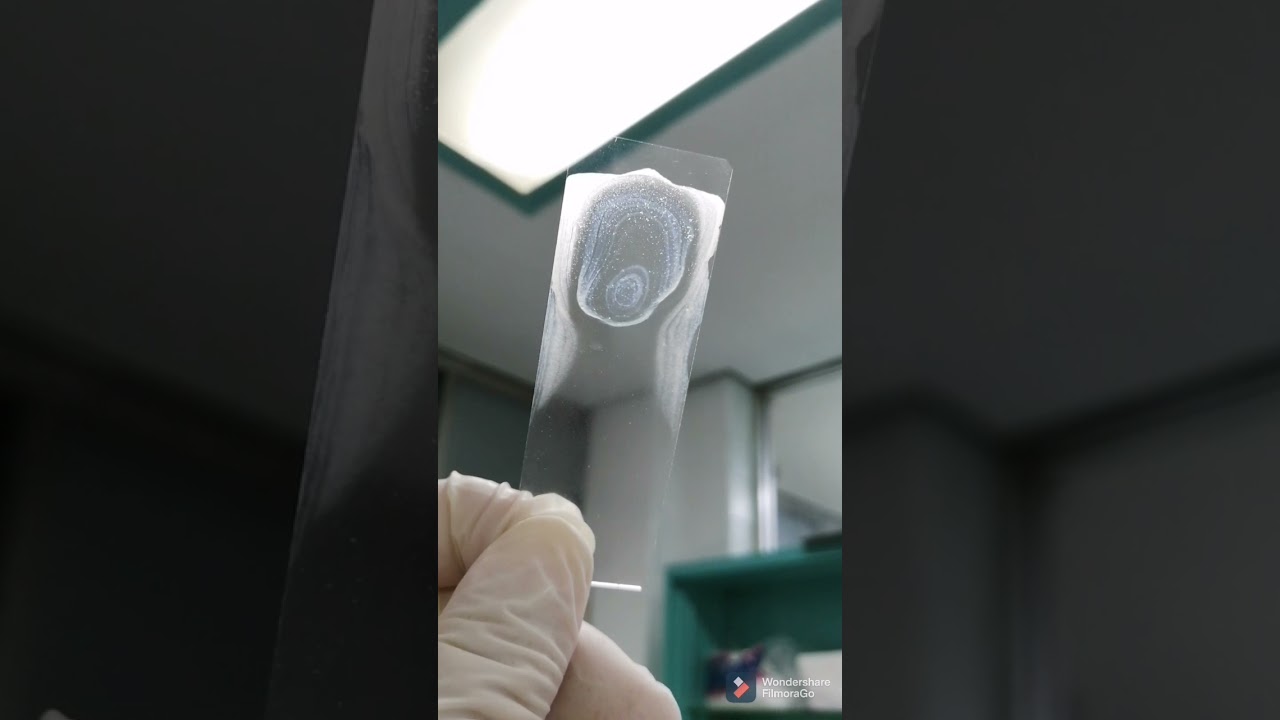 Tinción Gram de sedimento urinario/ Gram staining  from a Urine  sample