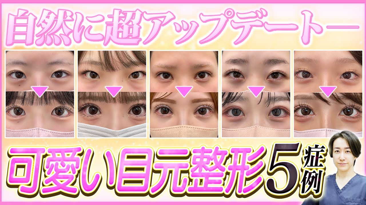 【垢抜け整形】タレ目形成でナチュラルな可愛い大きな目元を手に入れる！目元整形のプロが5名の症例を徹底解説します【デカ目 整形】