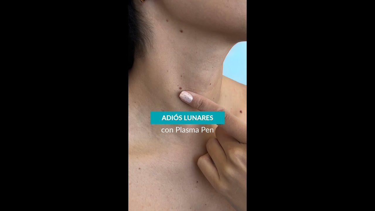 CAUTERIZACI&Oacute;N DE LUNARES