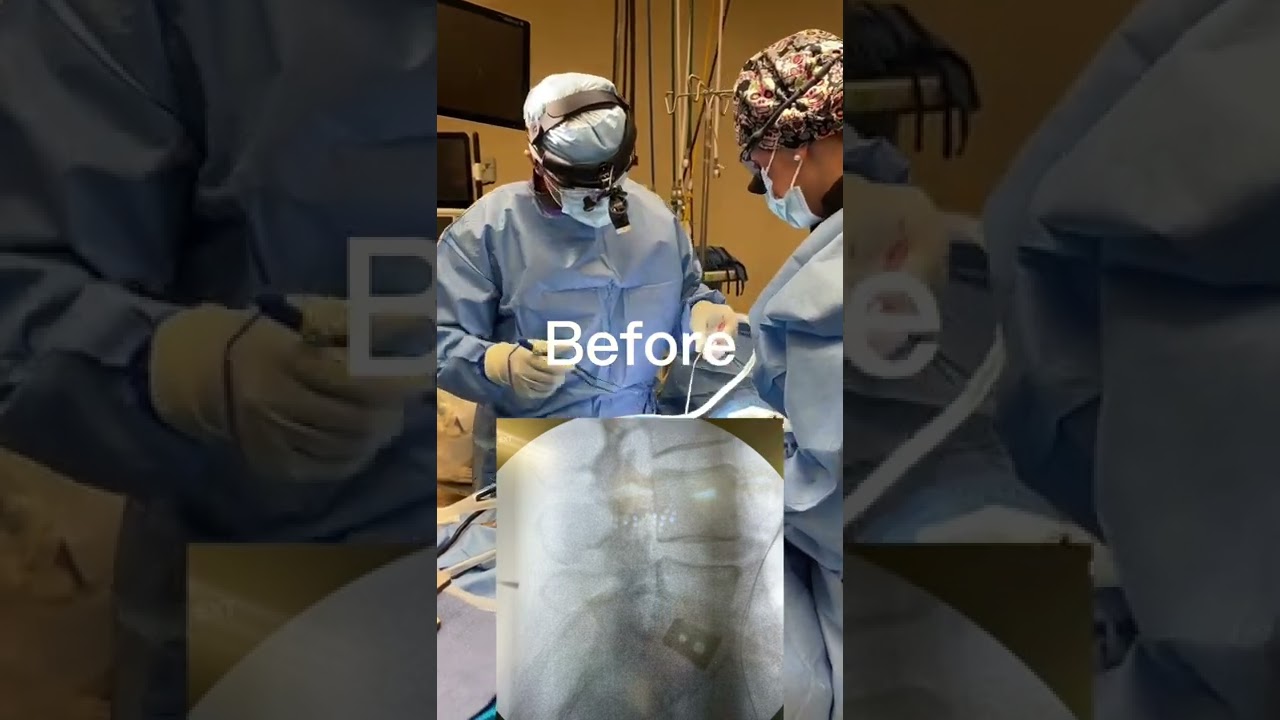 Revision lumbar fusion ￼ #spine #Neurosurgery #EDUCATION #Health #Medical #Surgery