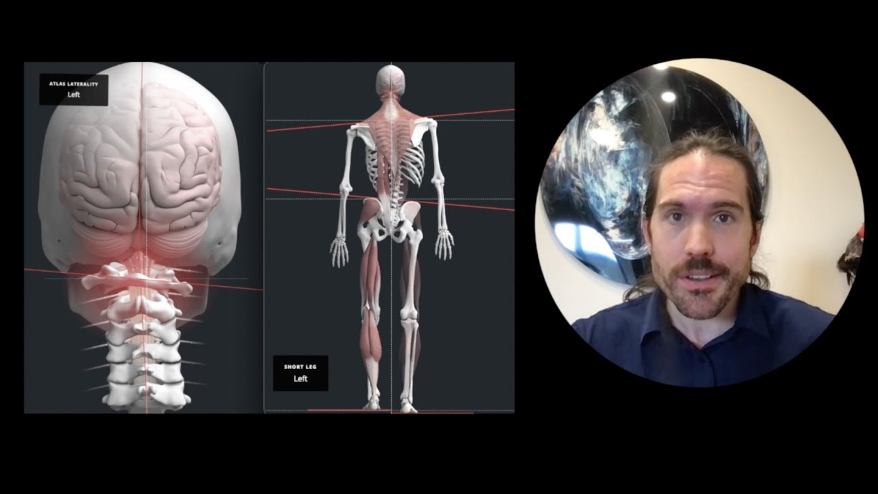 Head Posture affects Vertigo, Dizziness  & Sciatica | Upper Cervical Chiropractor Spokane