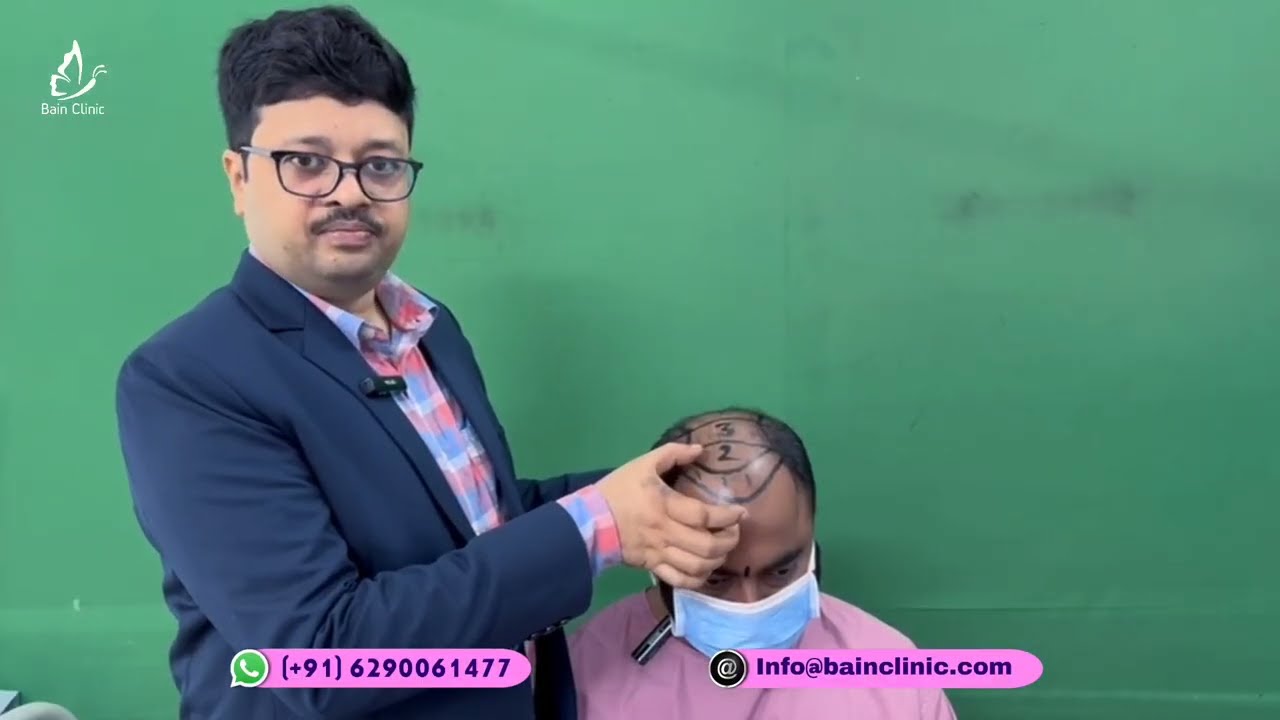 হেয়ার ট্রান্সপ্লান্ট নিয়ে আলোচনা  | হেয়ার ট্রান্সপ্লান্ট মার্কিং এবং প্ল্যানিং | ডা. জয়ন্ত বাইন