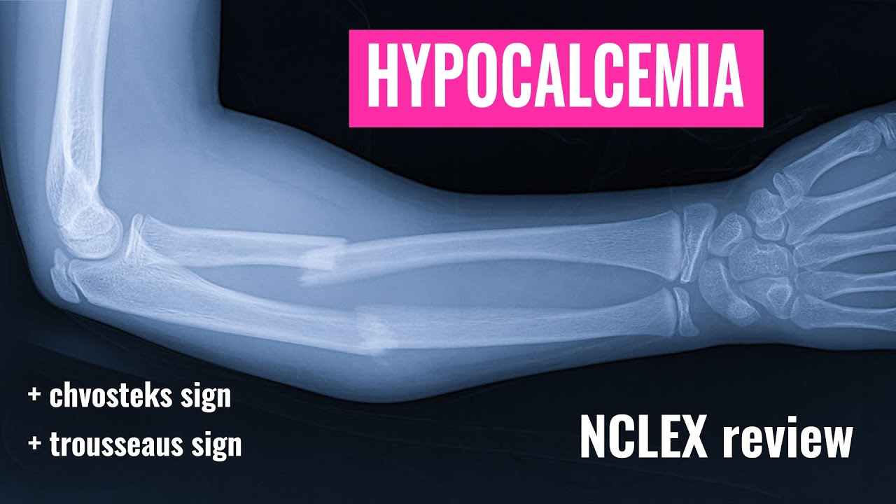 HYPOCALCEMIA FLUID & ELECTROLYTES |  LOW CALCIUM  | NCLEX Review | Christina NP | Caring Casa