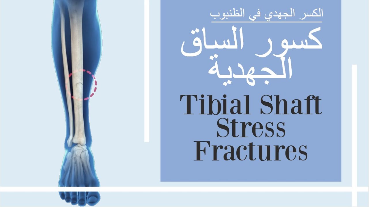 الألم الأمامي في عظمة الساق الذي يزداد بالحركة- الكسر الجهدي في عظمة الساق- الظنبوب  stress fracture