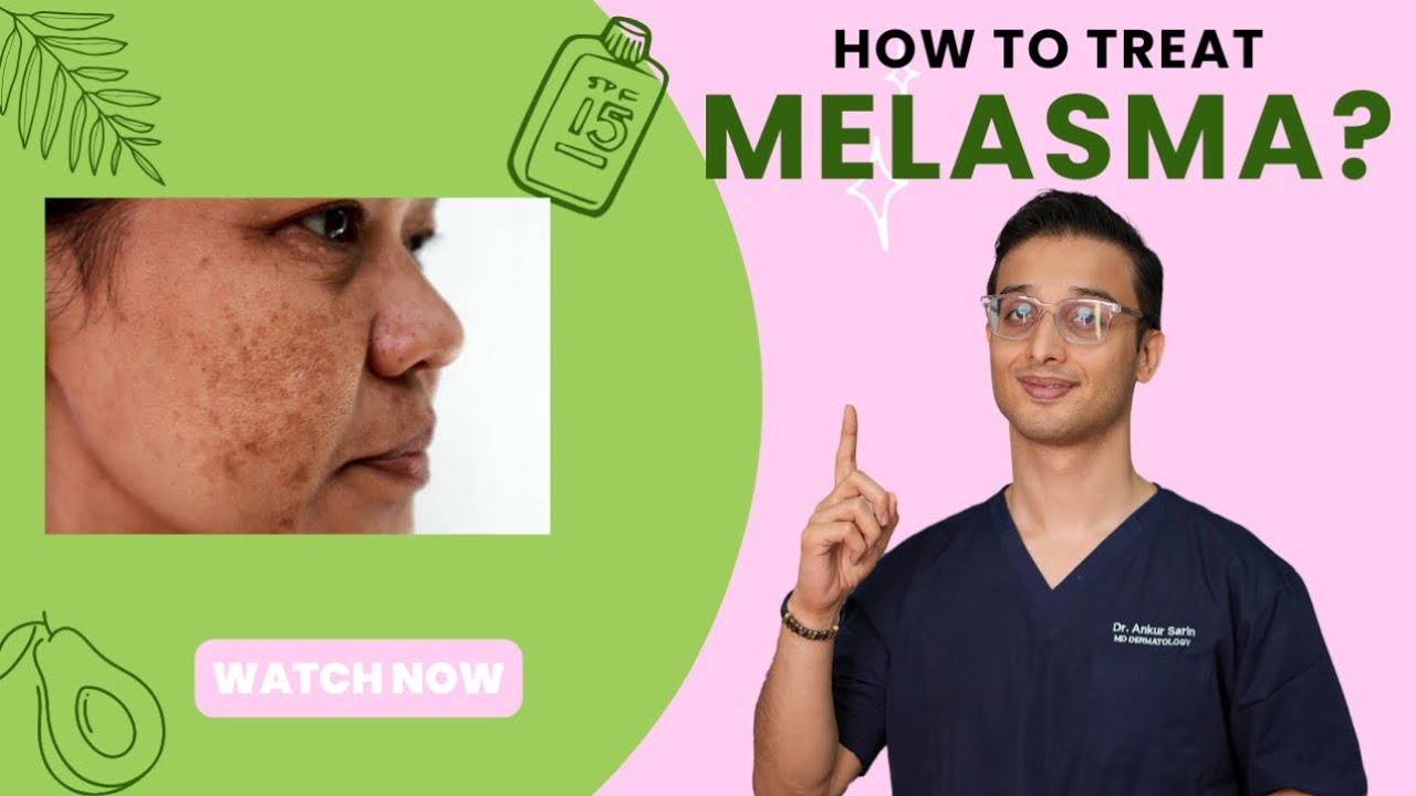 Melasma Treatment and Cure | laser treatment | Home Treatment | Dr. Ankur Sarin
