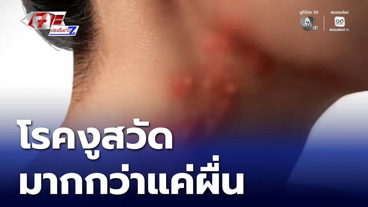 งูสวัด มากกว่าแค่ผื่นบนผิวหนัง | เจาะประเด็นข่าว 7HD