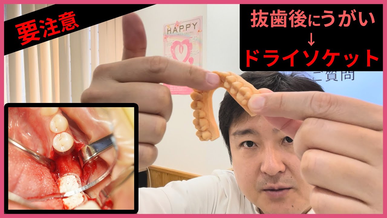 抜歯後の歯磨き・うがいどうする？歯科医師がドライソケットにならないための方法を伝授します！
