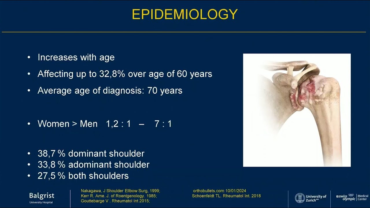 Balgrist erklärt: Glenohumerale Arthrose | Glenohumeral Osteoarthritis