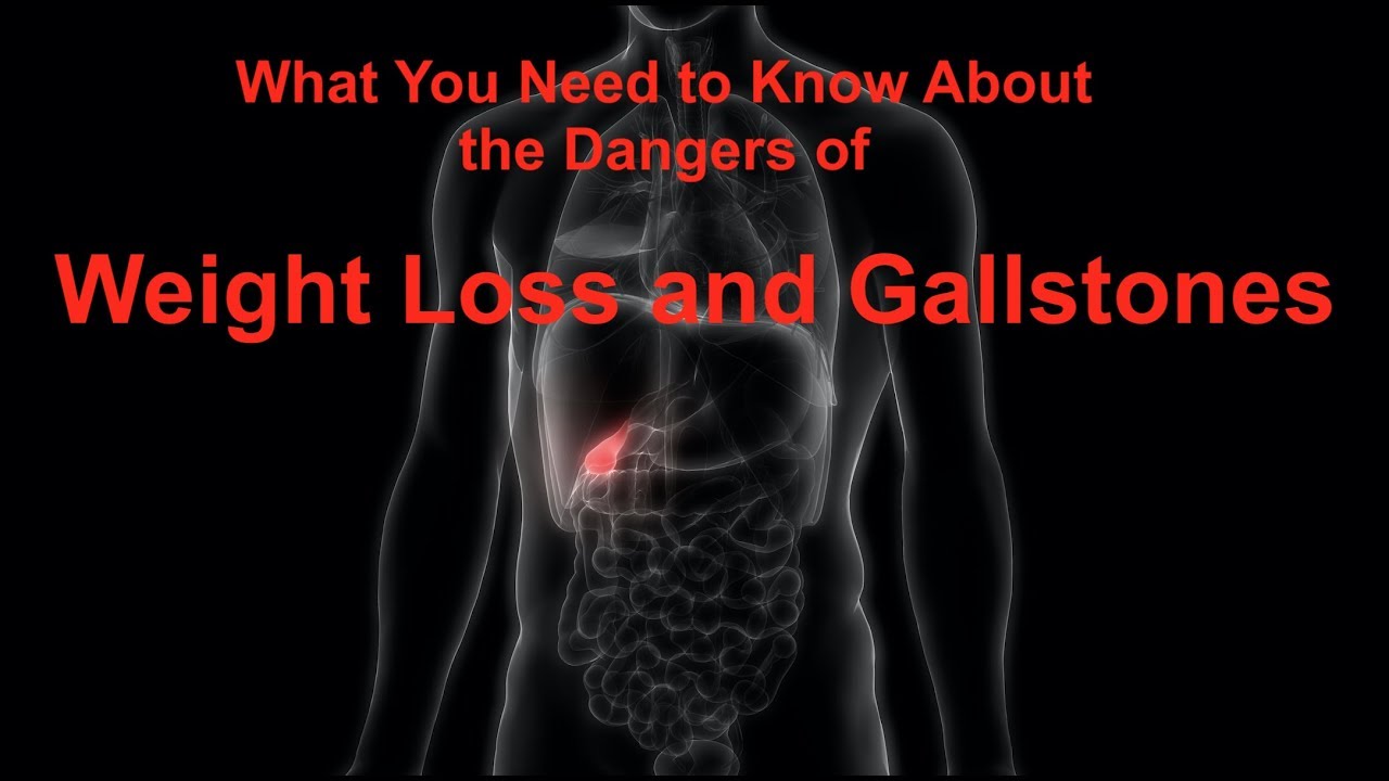 What You Need to Know About the Dangers of Weight Loss and Gallstones