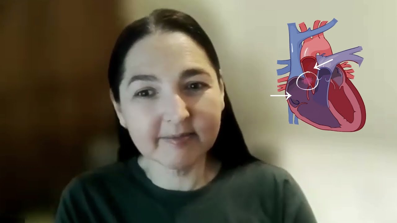 PFO closure after stroke, we share our experiences