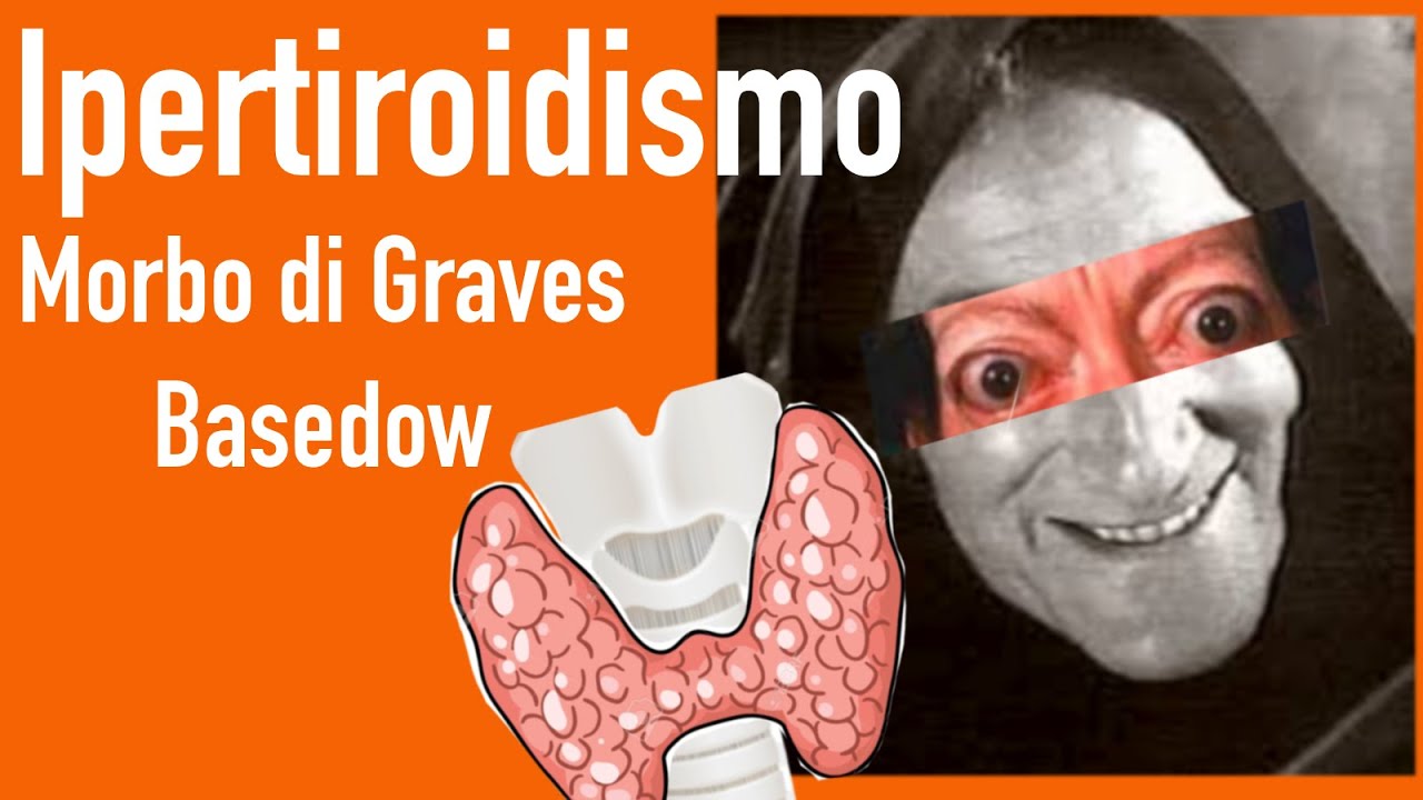 Ipertiroidismo e Morbo di Graves Basedow