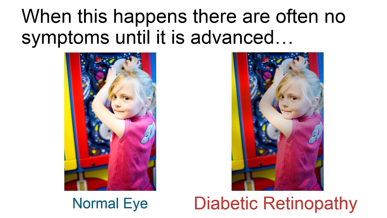 Diabetes Eye Care