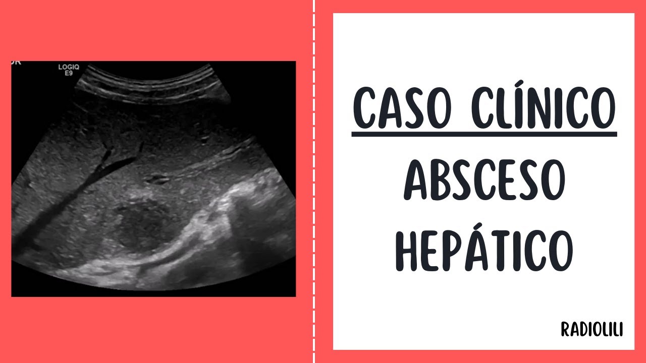 Absceso hepático: Caso clínico radiológico.