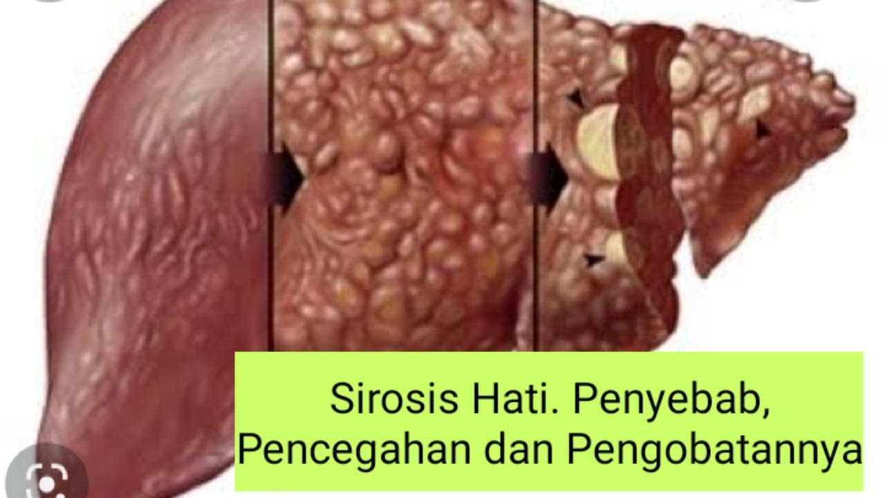 Sirosis Hati. Penyebab, Pencegahan dan Pengobatannya
