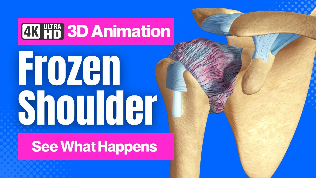 Frozen Shoulder (Adhesive Capsulitis) - 4K 3D Animation