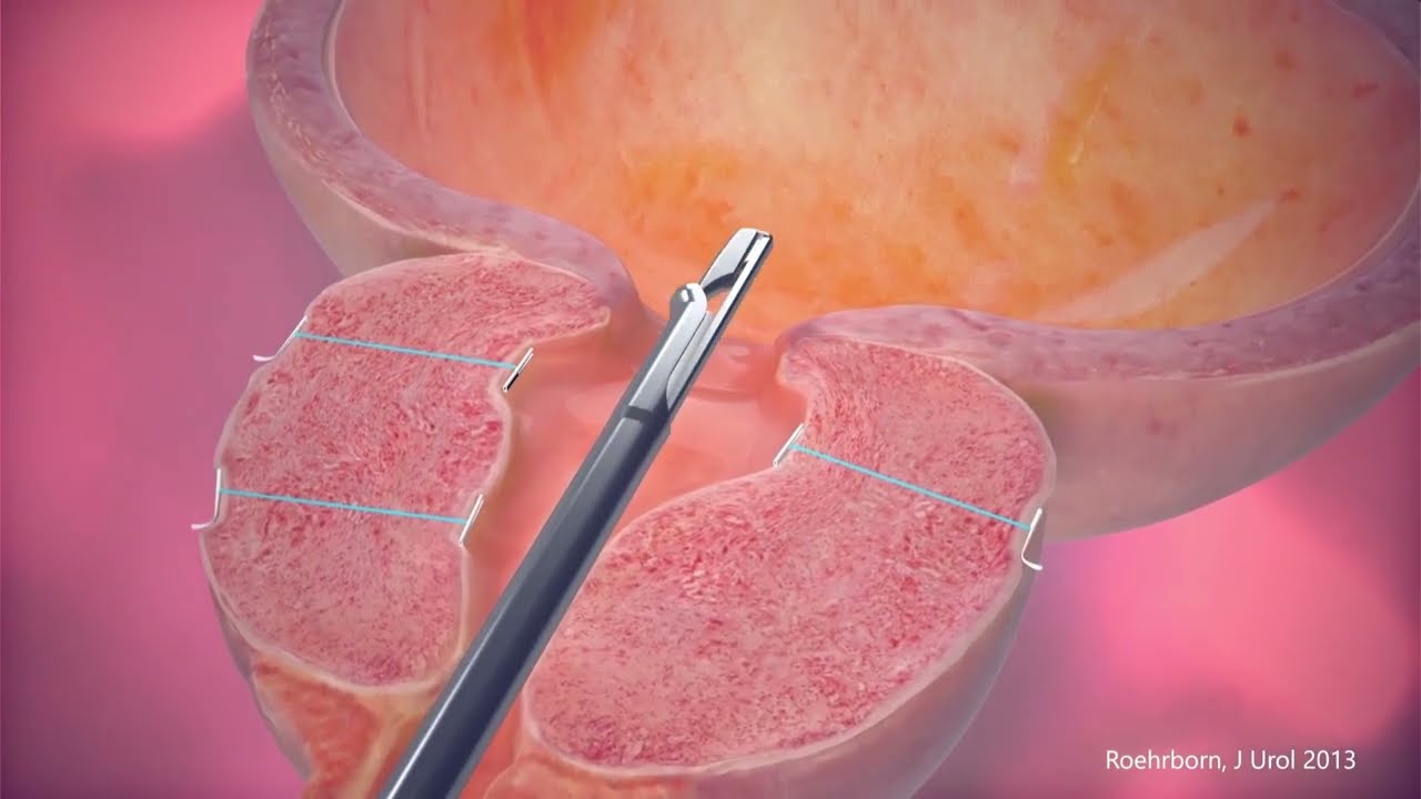 The UroLift System - Animation Video (ENGLISH)