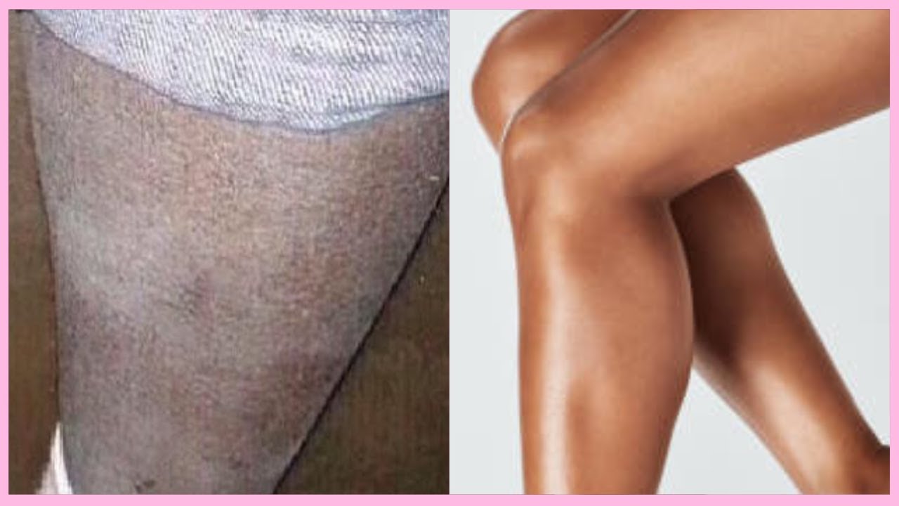 GET RID OF DRY ASHY SKIN WITH ANCIENT COSMETICS BODY BUTTER