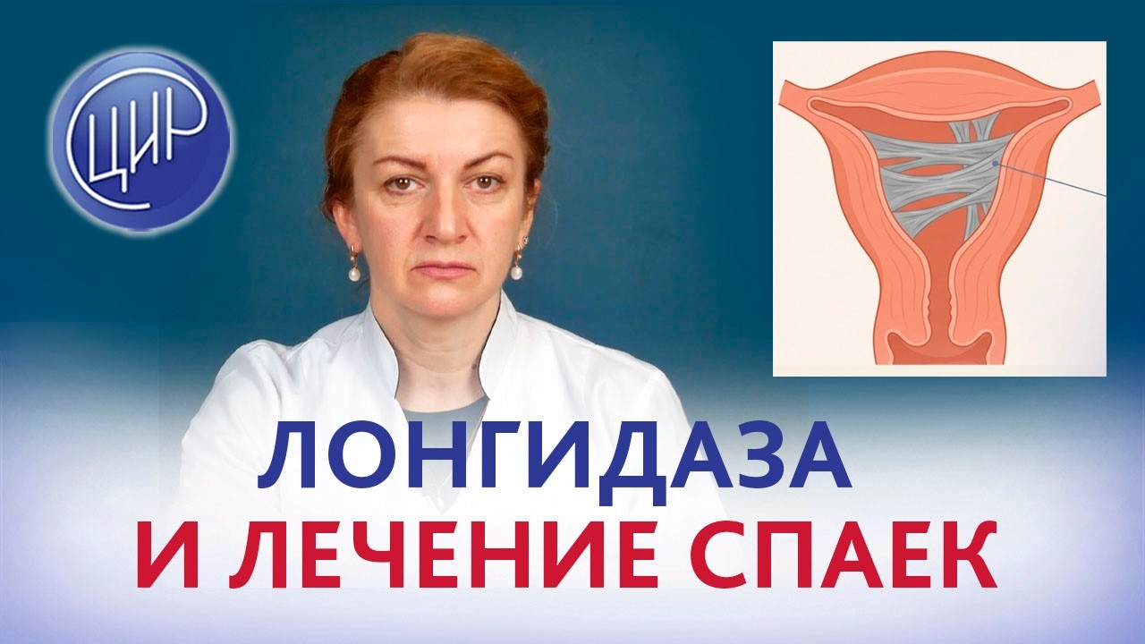 Лонгидаза. Эффективность лонгидазы при спайках в матке. Акушер-гинеколог ЦИР, С. Н. Дементьева.