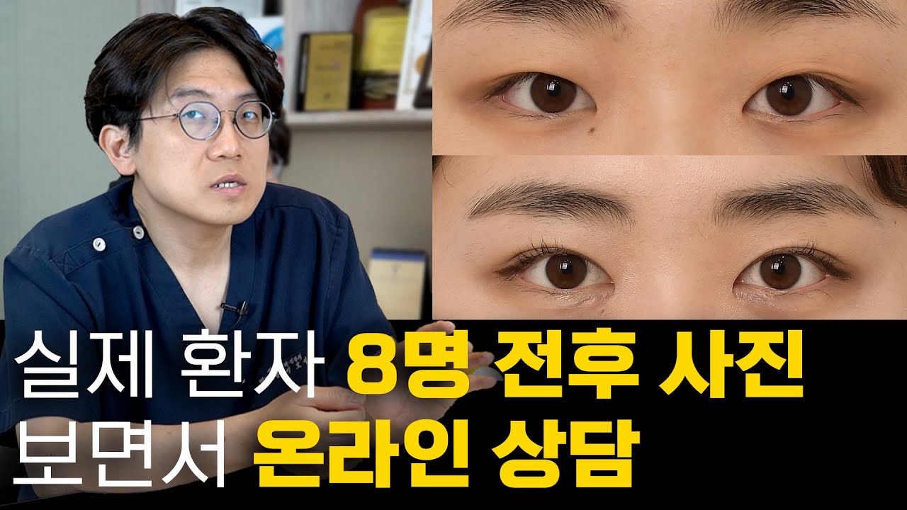 (온라인 상담)실제 환자 8명 /절개,비절개,두줄따기,눈매교정/ 자신의 눈과 비교해 보세요