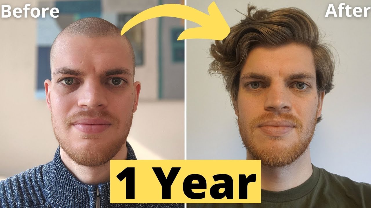 Hair Growth Time Lapse 12 Months Men (1 YEAR) - From Buzz Cut
