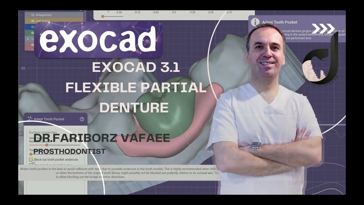 Как спроектировать гибкий частичный протез в exocad3.1rijka (часть 2)