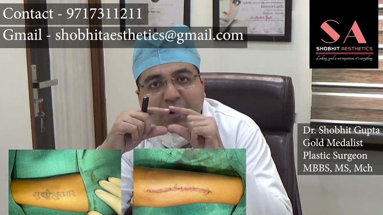 What is Tattoo Removal | Various Procedures of Tattoo Removal | Permanent Tattoo Removal (in Hindi)