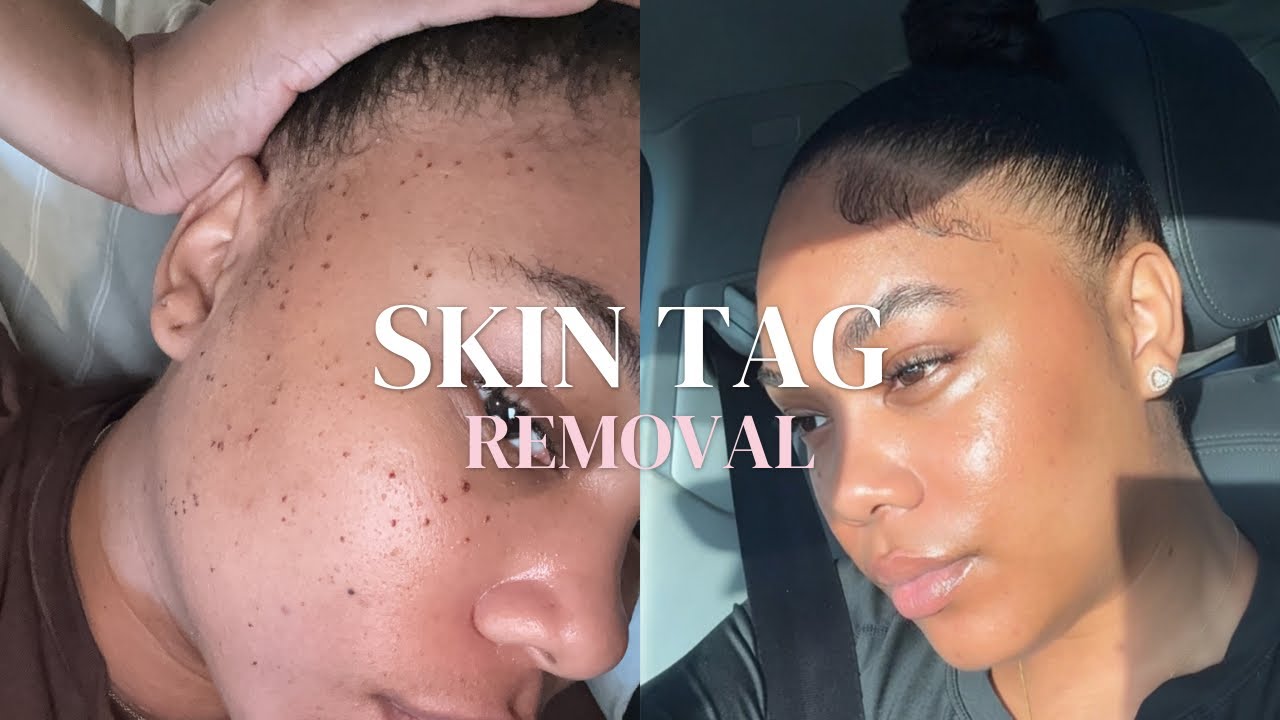 Dermatologist Skin Tag Removal Experience | Before & After Results. Process + Healing