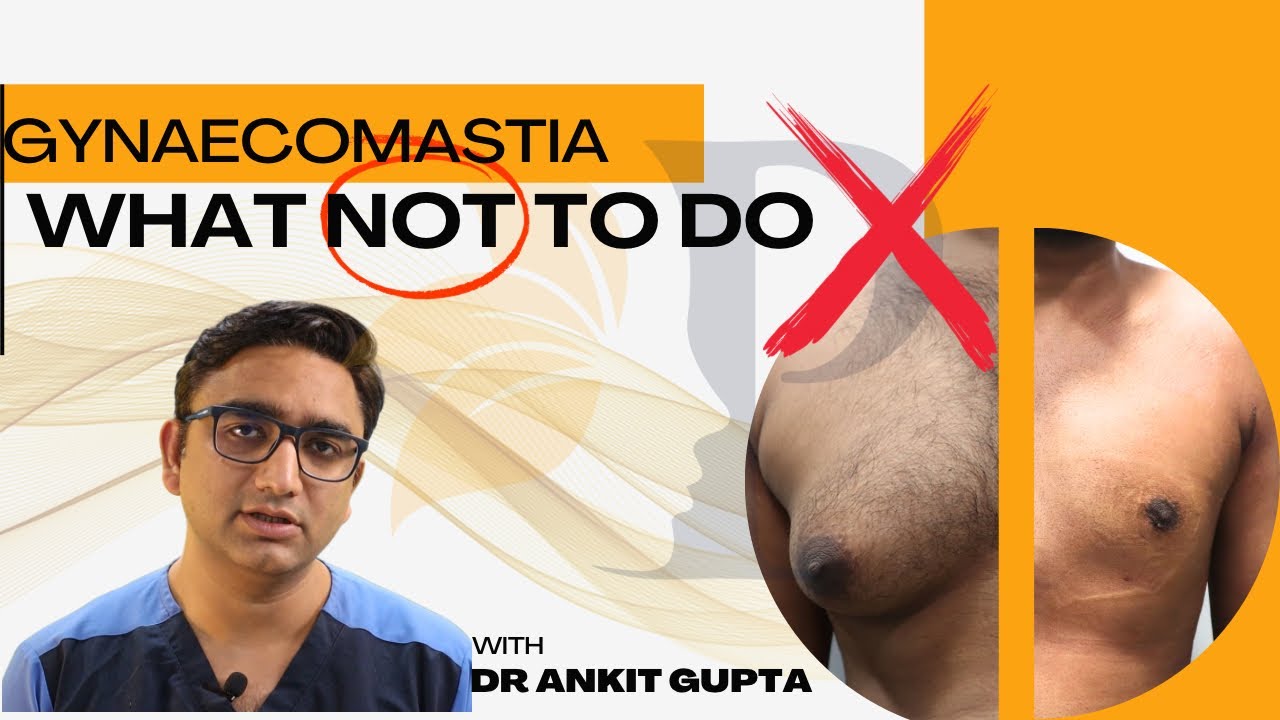 What Works and What Doesn't in Gynecomastia. Diet and Exercise for Gynecomastia