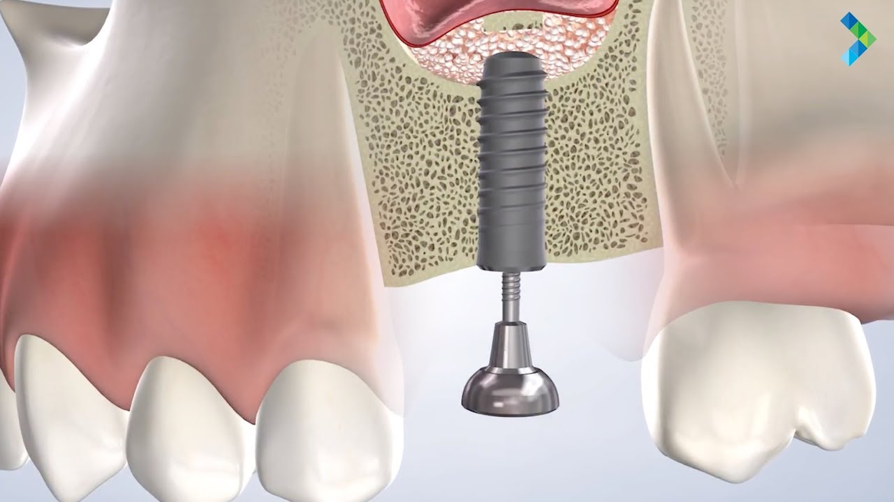 Socket Preservation in Danbury CT | Greater Connecticut Oral & Dental Implant Surgery