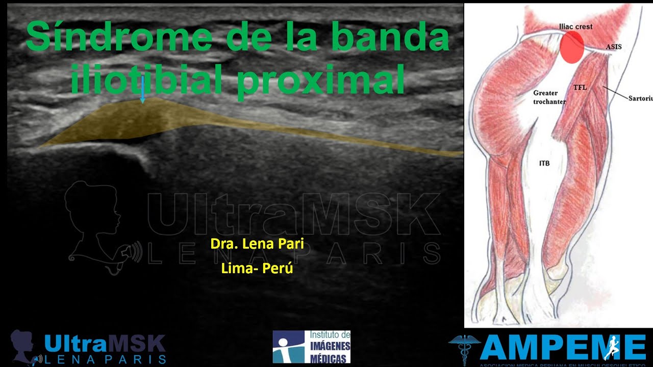 Como evaluar el síndrome de la banda iliotibial proximal en ultrasonido.