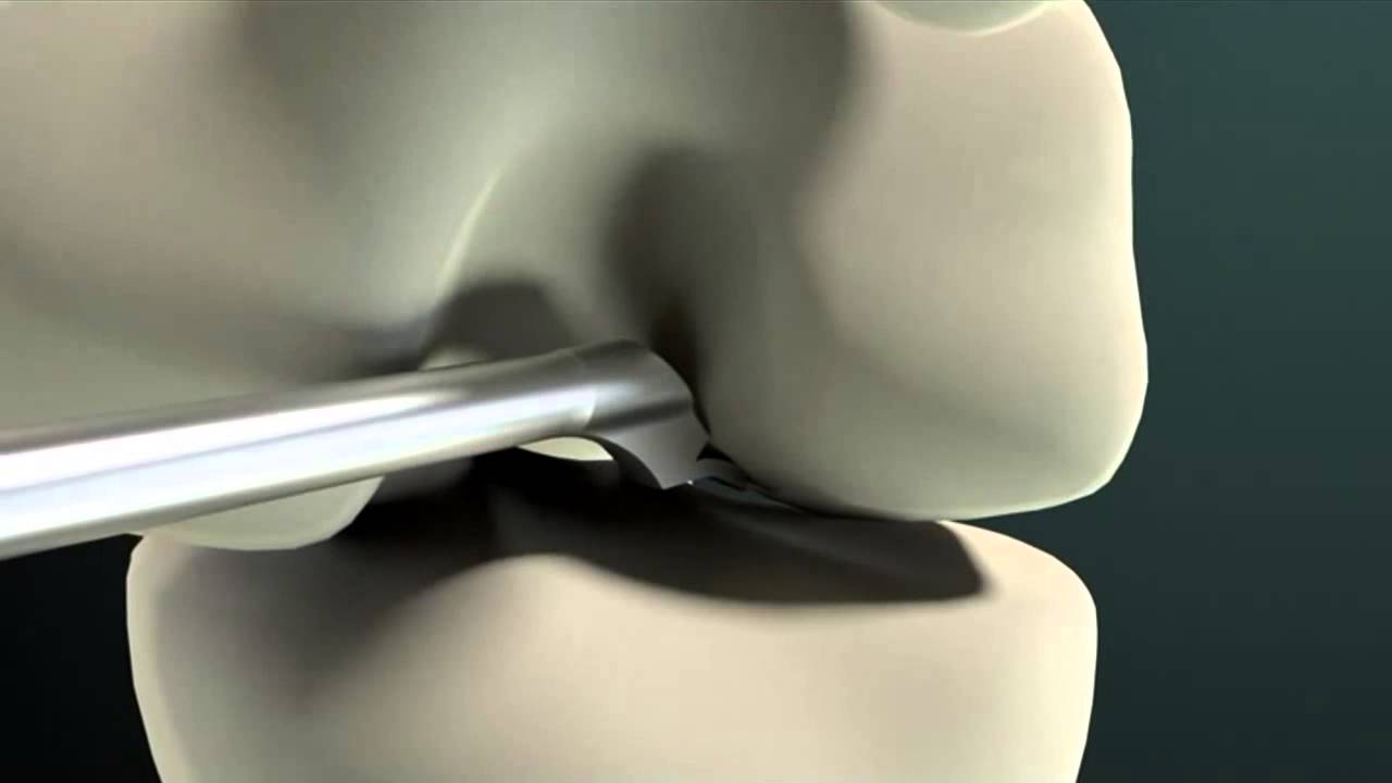 Implant T-Lock (PLLA-uHA) firmy Richard Wolf GmbH do rekonstrukcji ACL