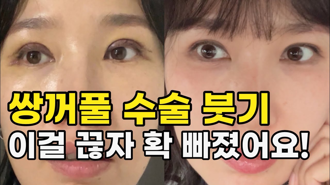 쌍수 Q&A, 병원 정보, 붓기 뺀 방법