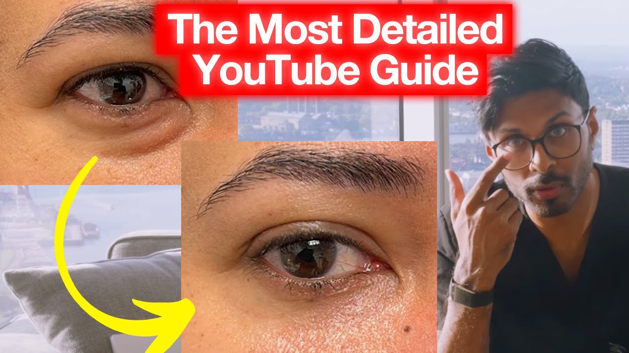 How To Get Rid Of Under Eye Bags, Hollows, Puffiness, Dark Circles (YouTube's Biggest Guide?)