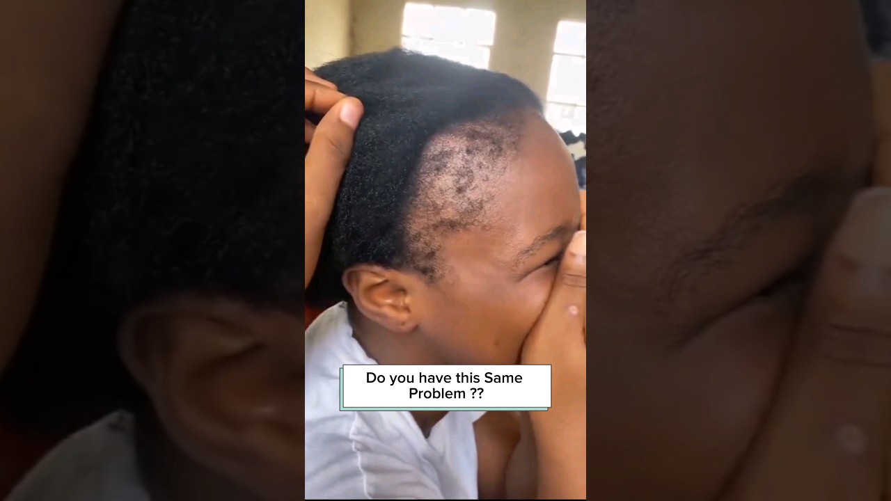 Hair Loss Around Your Edges ? #solution  #shortsfeed  #haircare #4k #4c