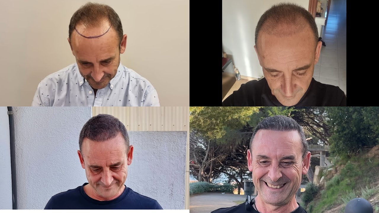 7 MESES DE MI INJERTO CAPILAR