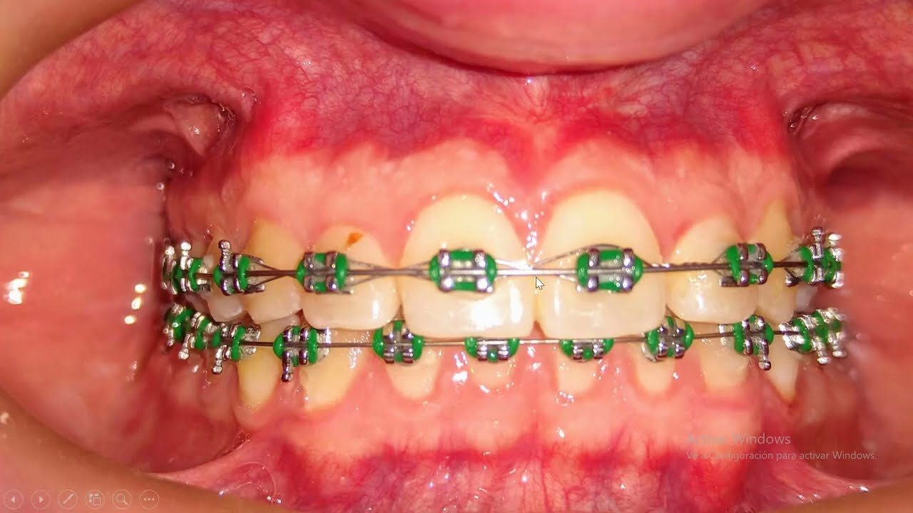 Como se soluciona una mordida profunda de manera sencilla en Ortodoncia?? ANTES  Y DESPUÉS 😎