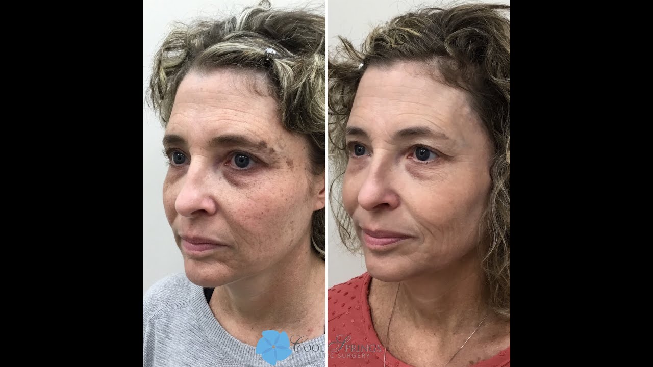 REVERSE THE SIGNS OF AGING with Sciton Lasers Options: BBL, Halo, TRL, CO2