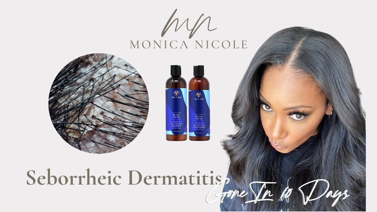 How I Finally Healed My Seborrheic Dermatitis In Just 10 Days!