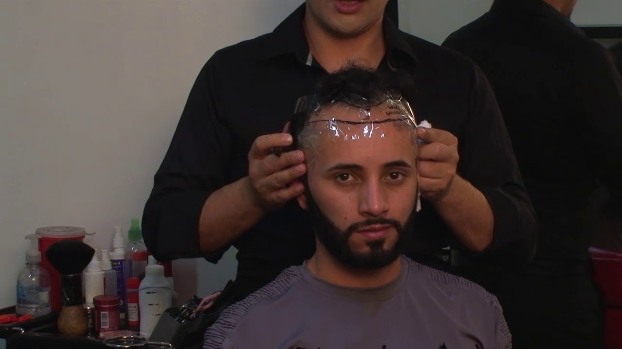 Prótesis capilares para entradas - Hair Implant