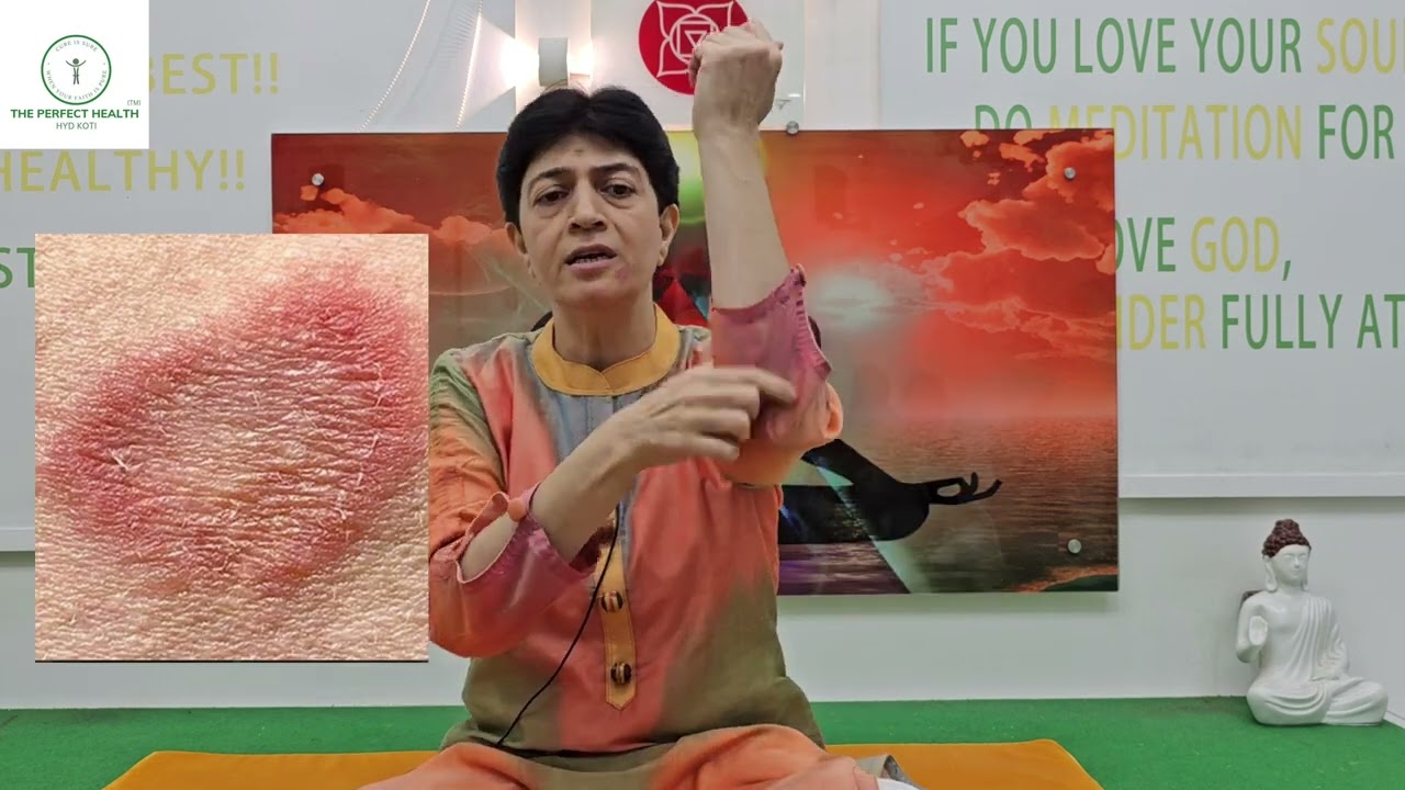 ECZEMA, PSORASIS, RINGWORM AND ALL SKIN DISEASES