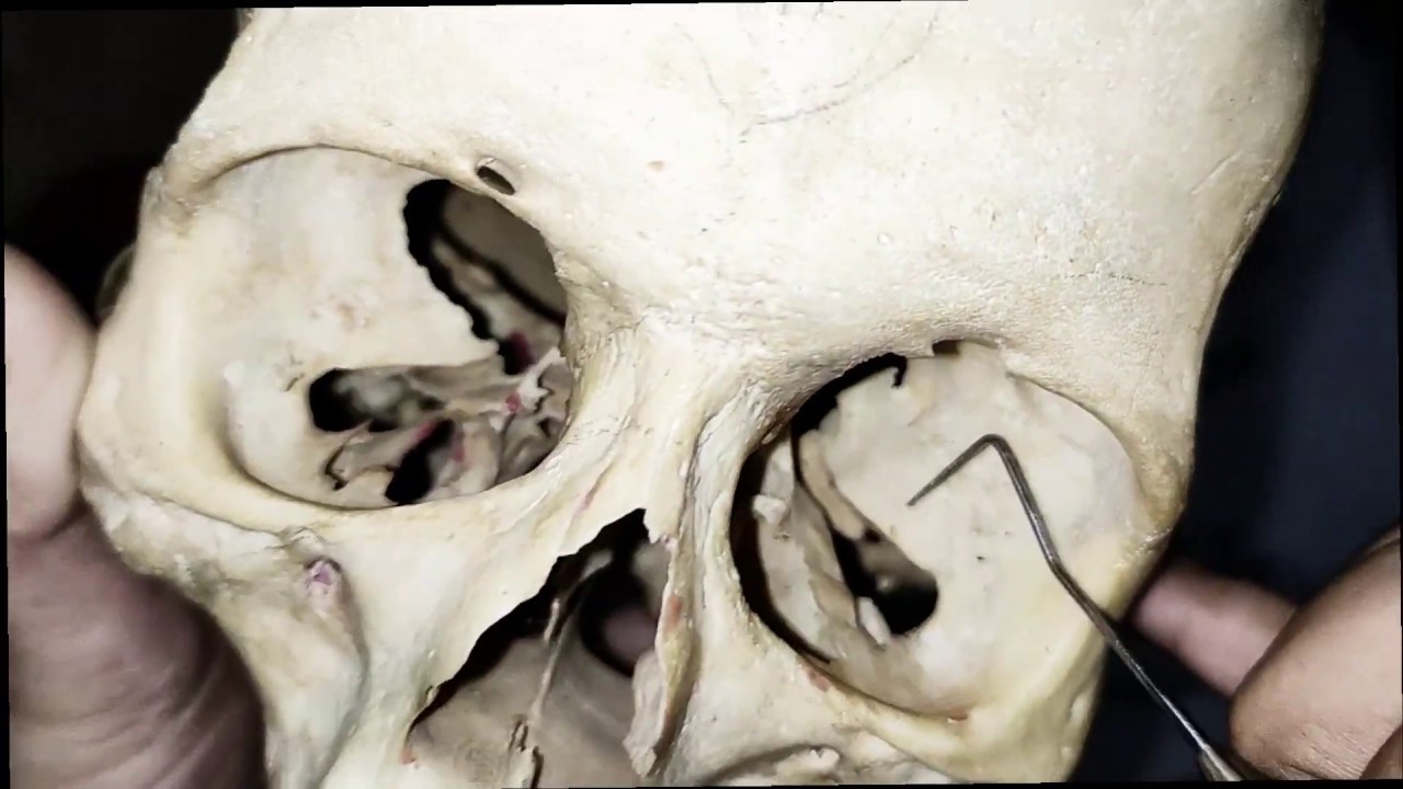 lefort 3 fracture - line and clinical features