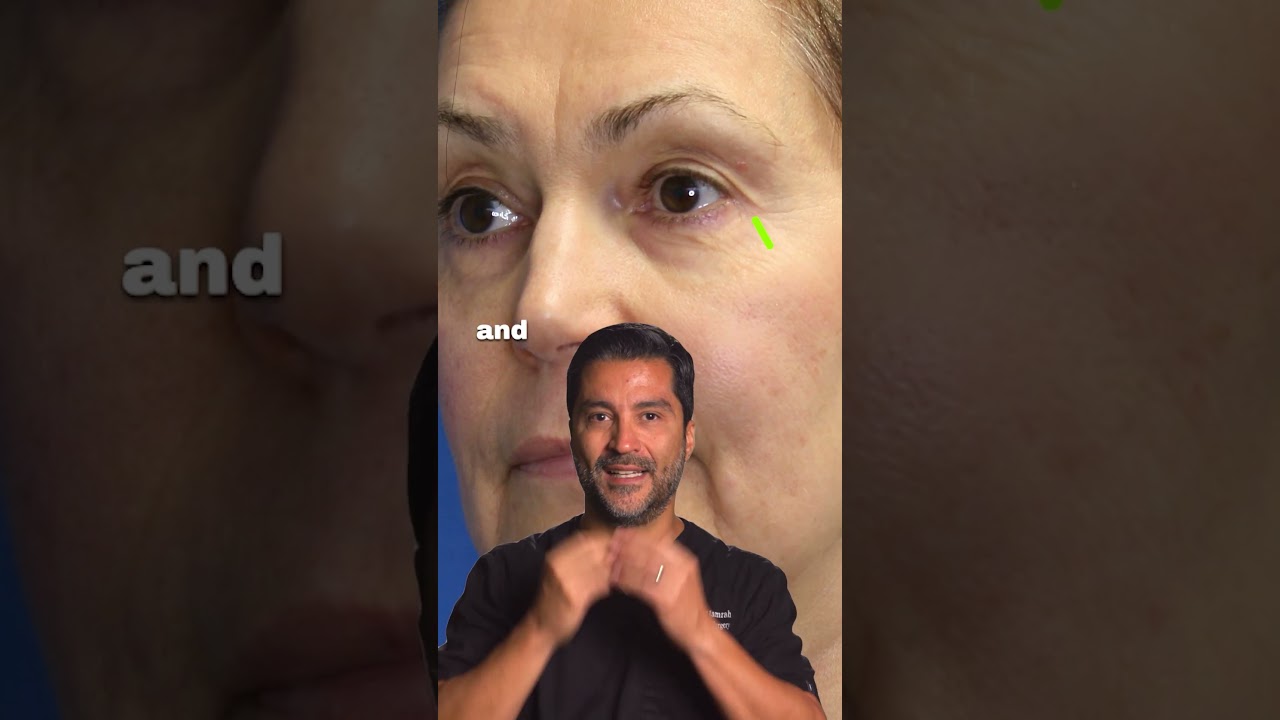 Facial aging - How it works #facialrejuvenation #faceliftsurgery #antiage