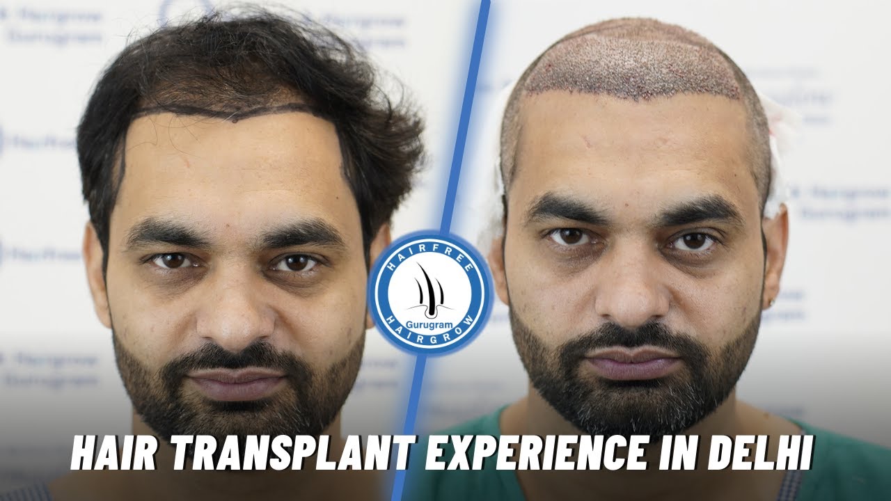 My Hair Transplant Journey With The India’s Best Hair Transplant Clinic in Delhi  #hairfreehairgrow