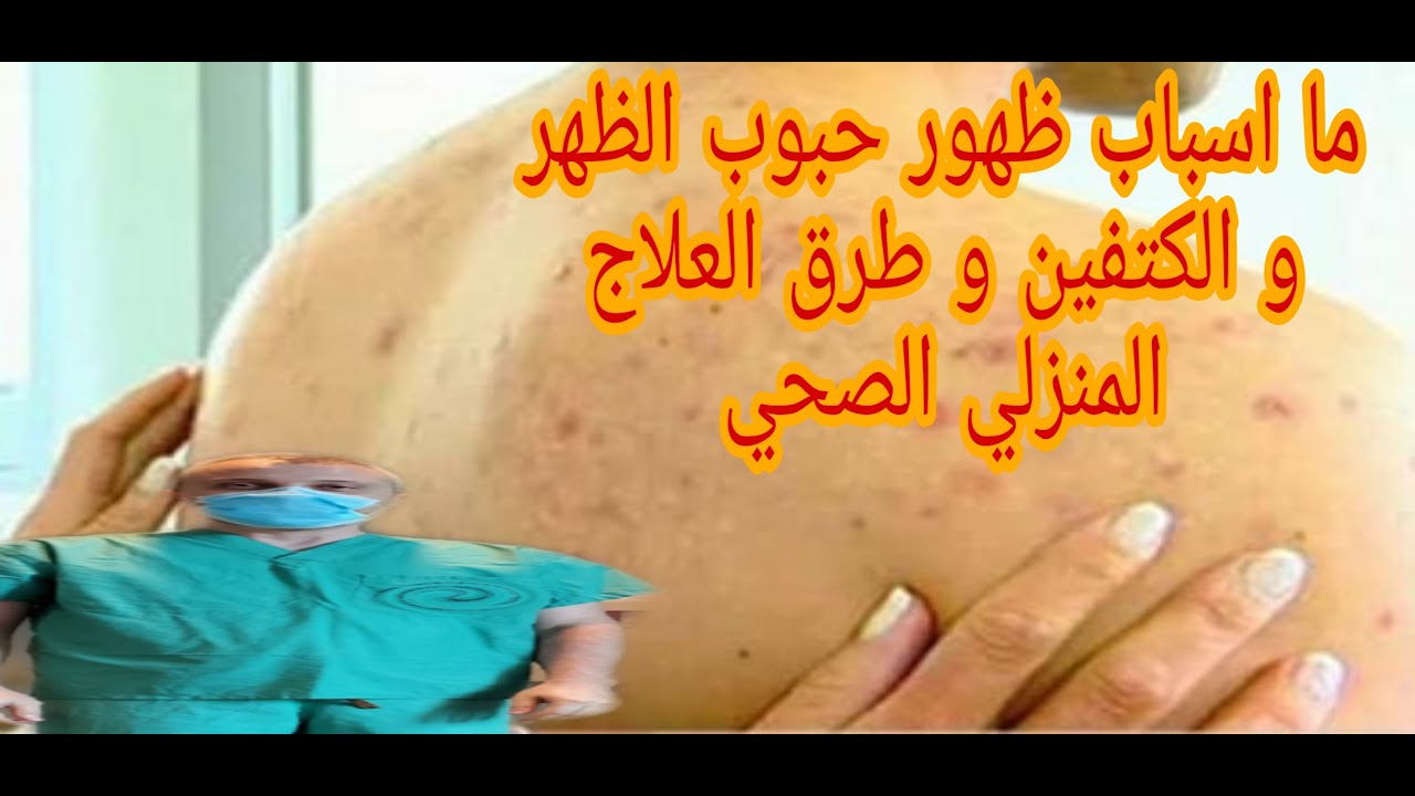 ما اسباب ظهور حبوب الكتفين و الظهر و طرق العلاج المنزلي الصحي