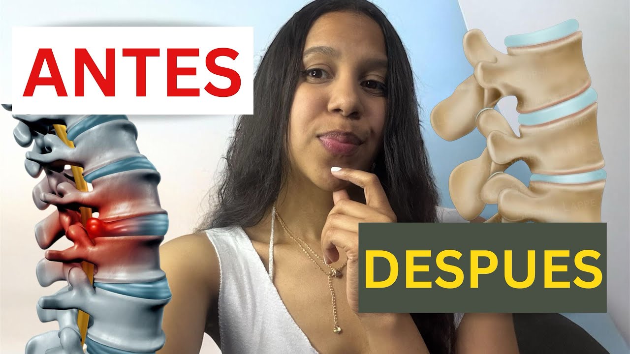 Ejercicios para hernia discal | Haz esto antes de pensar en cirugía ‼️