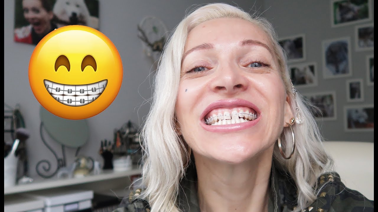 Heute Zahnspange Bekommen! Vlog 7/2018